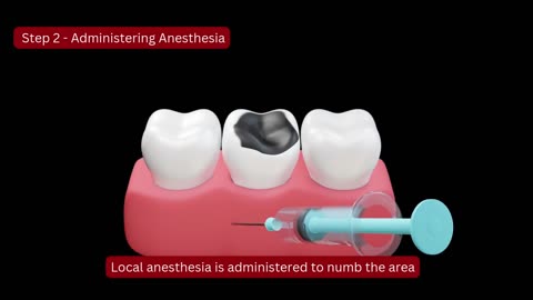 Tooth extraction - Best Dental Clinic in Bannerghatta Road- Bangalore