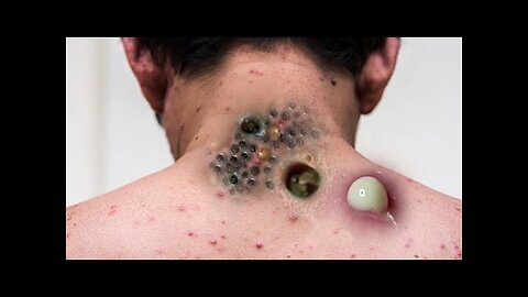 Huge blackhead extraction