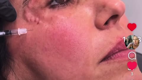 You have NEVER SEEN EYELID TOX LIKE THIS & PERFECT crows expl!