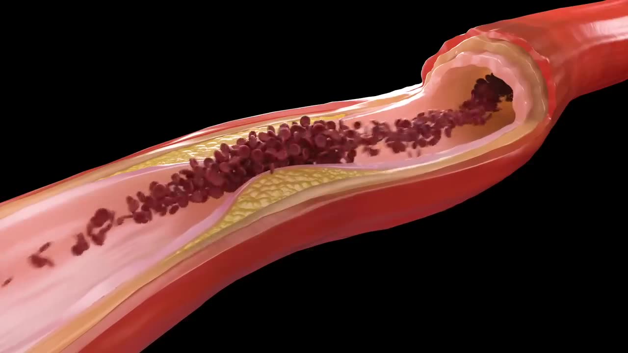 Why FISH OIL Can Prevent Sudden Cardiac Death and Arrhythmias...