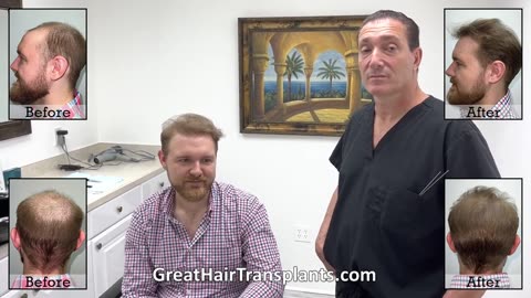Dillon’s MaxHarvest™ Plus Corrective Hair Transplant by Dr. Brett Bolton