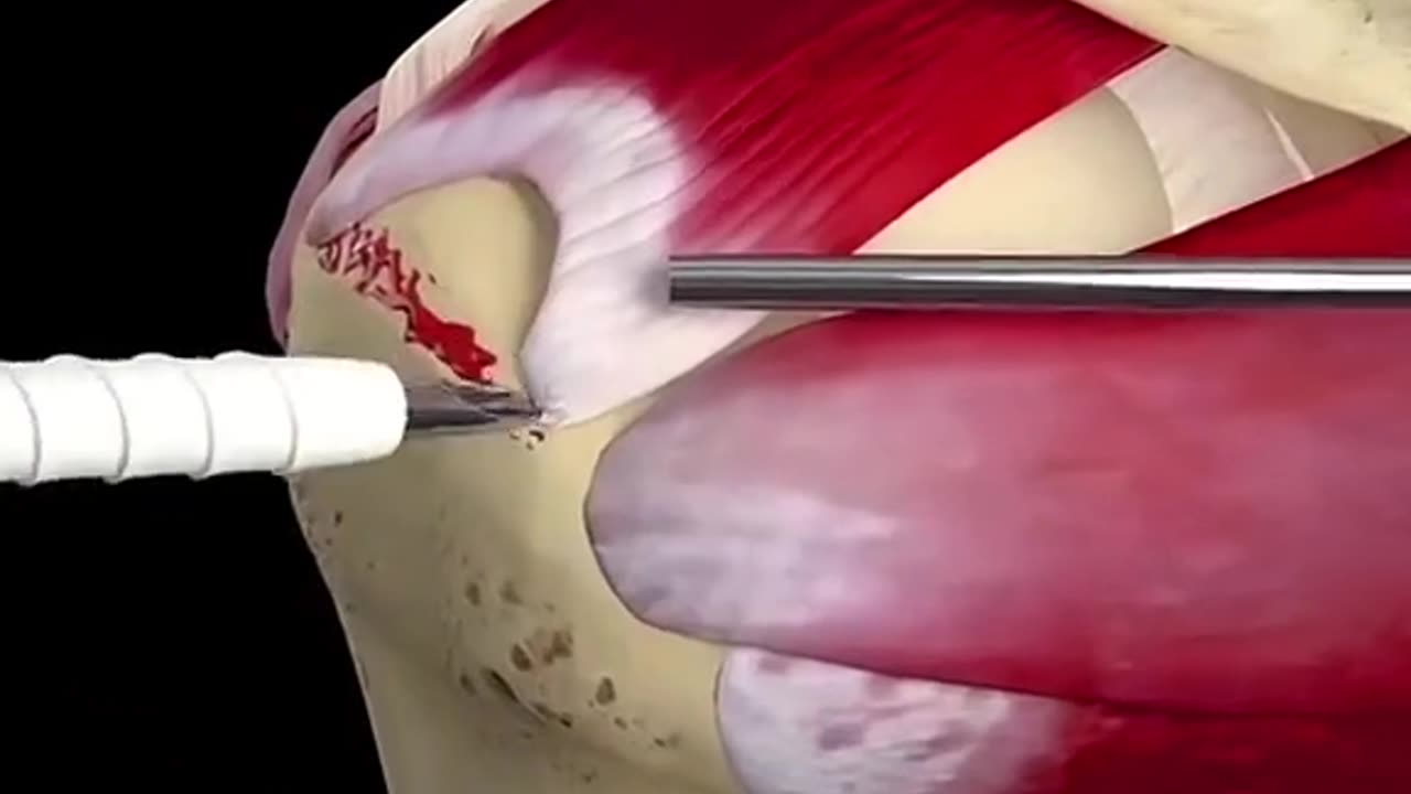 Rotator Cuff Repair Surgery (3D Animation)