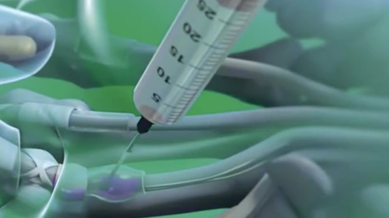 Trigger Finger Release (3D Animation)