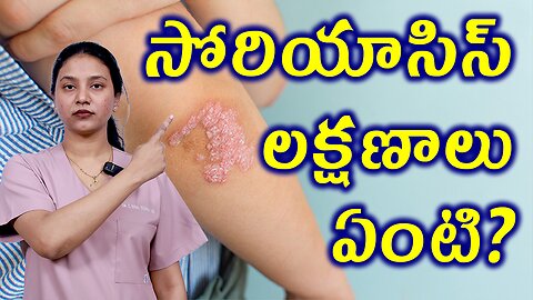 సోరియాసిస్ లక్షణాలు ఏంటి ? What are the Signs of Psoriasis ? Homeopathy Treatment Cure Medicine