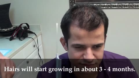 Dr. Brett Bolton Hair Transplant Suture Removal | MaxHarvest™ Results