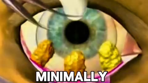 How Eye Wrinkle Removal Surgery Works - Watch the Transformation!