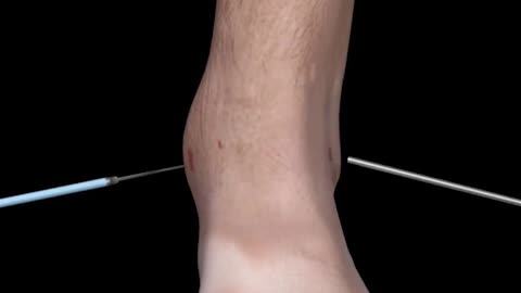 Ankle Spur Removal Surgery 3D Animation (Ankle Chilectomy)