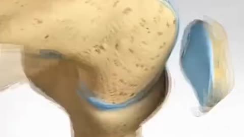 How Patella Replacement Surgery – How Surgeons Replace a Damaged Kneecap