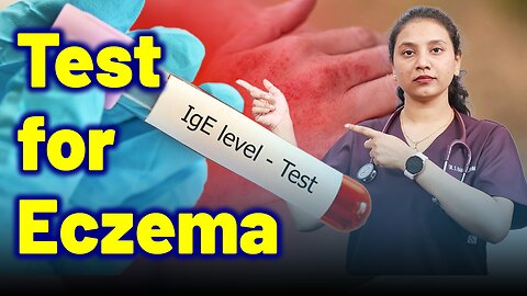 Test for Ecezma | Treatment Cure Relief Medicine | Skin Hair Nail | Homeopathy