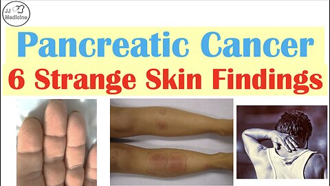 Your Skin Can Reveal Pancreatic Cancer: 6 Critical Clues