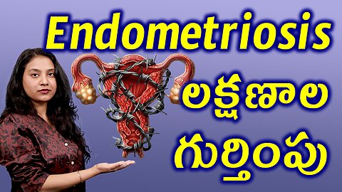 ఎండోమెట్రియోసిస్ లక్షణాల గుర్తింపు Signs and Symptoms of Endometriosis Treatment | హోమియోపతి