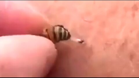 HONEYBEE VENOM KILLS CANCER CELLS 🐝
