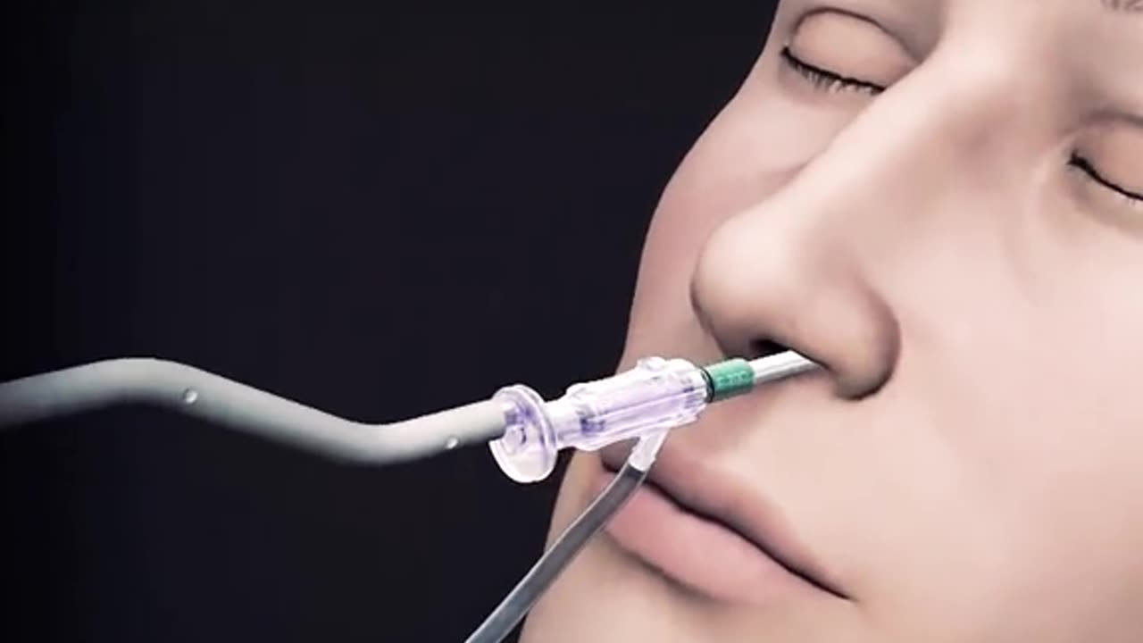 Balloon Sinuplasty Procedure 3D Animation