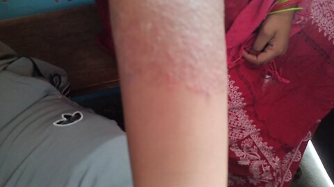 4 सालों से शरीर पर लाल दाद थें अब सही इलाज होने से फायदा मिला ।