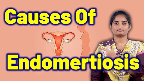 Risk Factors & Causes of Endometriosis | Uterine Tissue Growth Homeopathy Medicine Treatment & Cure