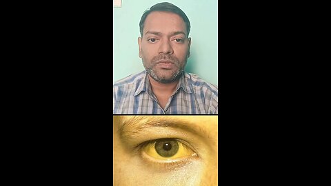 काला पीलिया किस बीमारी को कहते हैं ।
