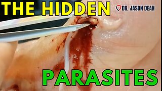 Dr. Jason Dean, BraveTV - Ep 1935 - The Hidden Parasites - Hidden Disease