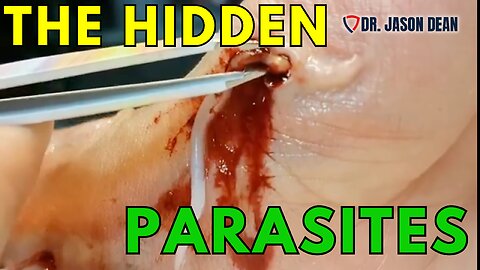 Dr. Jason Dean, BraveTV - Ep 1935 - The Hidden Parasites - Hidden Disease