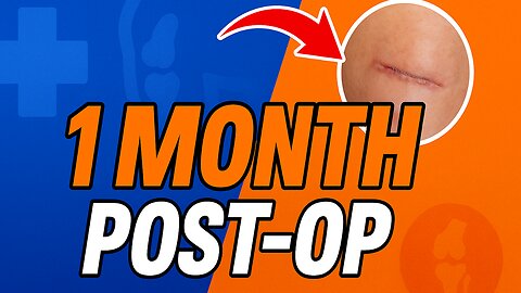 1 Month Post Op ACL Surgery