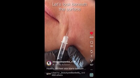 New technique I’m using with fine filler for my annoying superficial emoting wrinkles