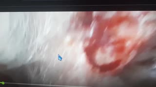 Diagnosed with basil cell carcinoma