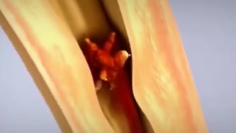 Kidney Stomes 3D Animation