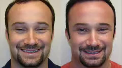 Dr. Brett Bolton Here We Go Again! Another Incredible Hair Transplant Result