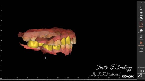 #design #naildesign #dental #dentaldesign #exocadexpert