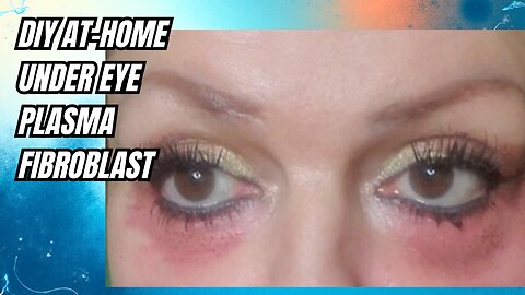 DIY at Home Plasma Fibroblast- Under Eyes