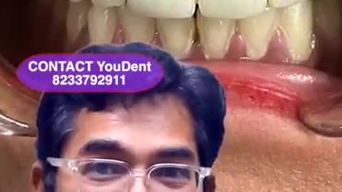 Best Dental Implant - Top Dental Clinic in : Amritsar