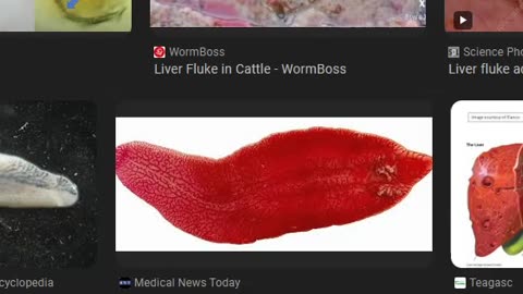 Liver Flukes in the Gall Bladder, or is it Gall Stones??