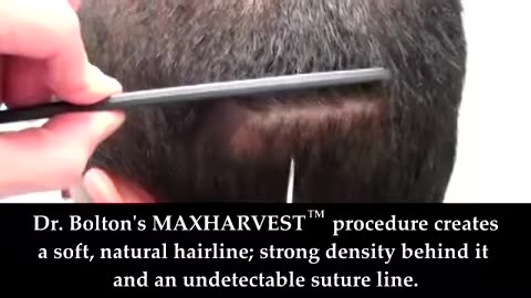 Undetectable Suture Line Hair Surgery – Dr. Brett Bolton