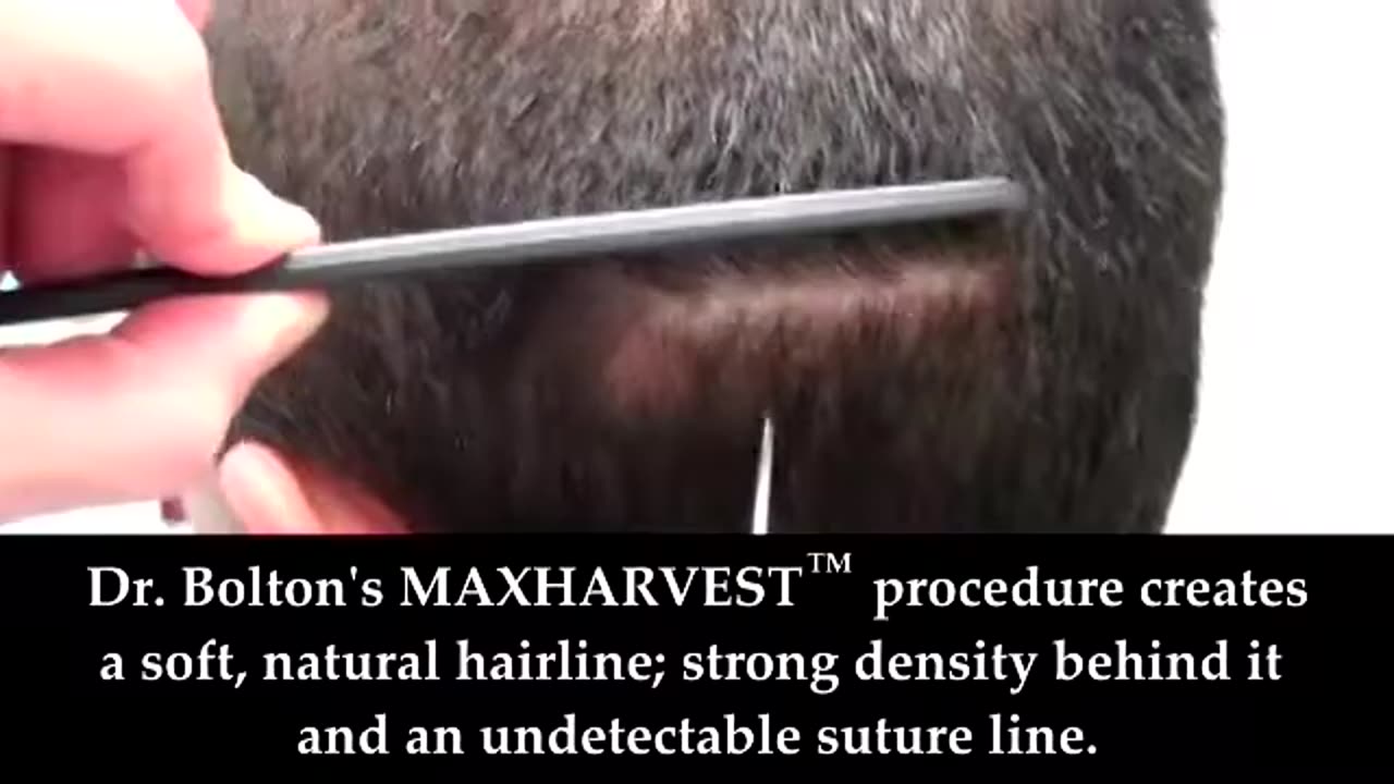 Undetectable Suture Line Hair Surgery – Dr. Brett Bolton