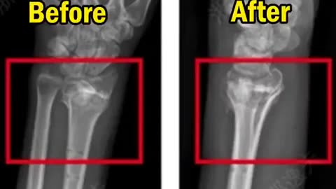🧠💉 China's First Bone Glue: Faster Healing in 3-5 Minutes! | FeedMyCuriosity