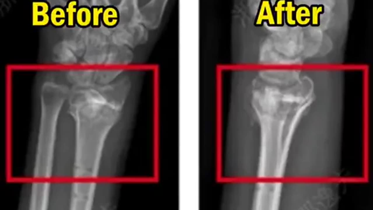 🧠💉 China's First Bone Glue: Faster Healing in 3-5 Minutes! | FeedMyCuriosity