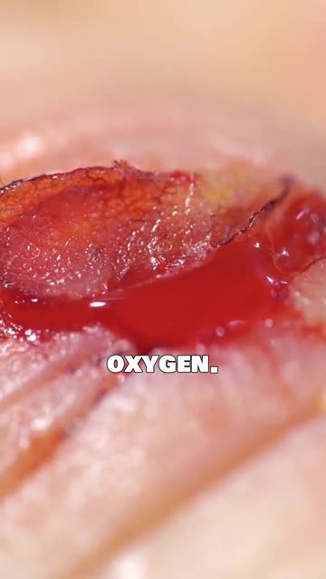 Perforated Bowel Explained: Life Threatening Warning Signs & Treatment