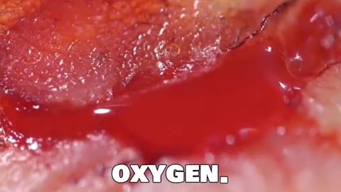 Perforated Bowel Explained: Life Threatening Warning Signs & Treatment