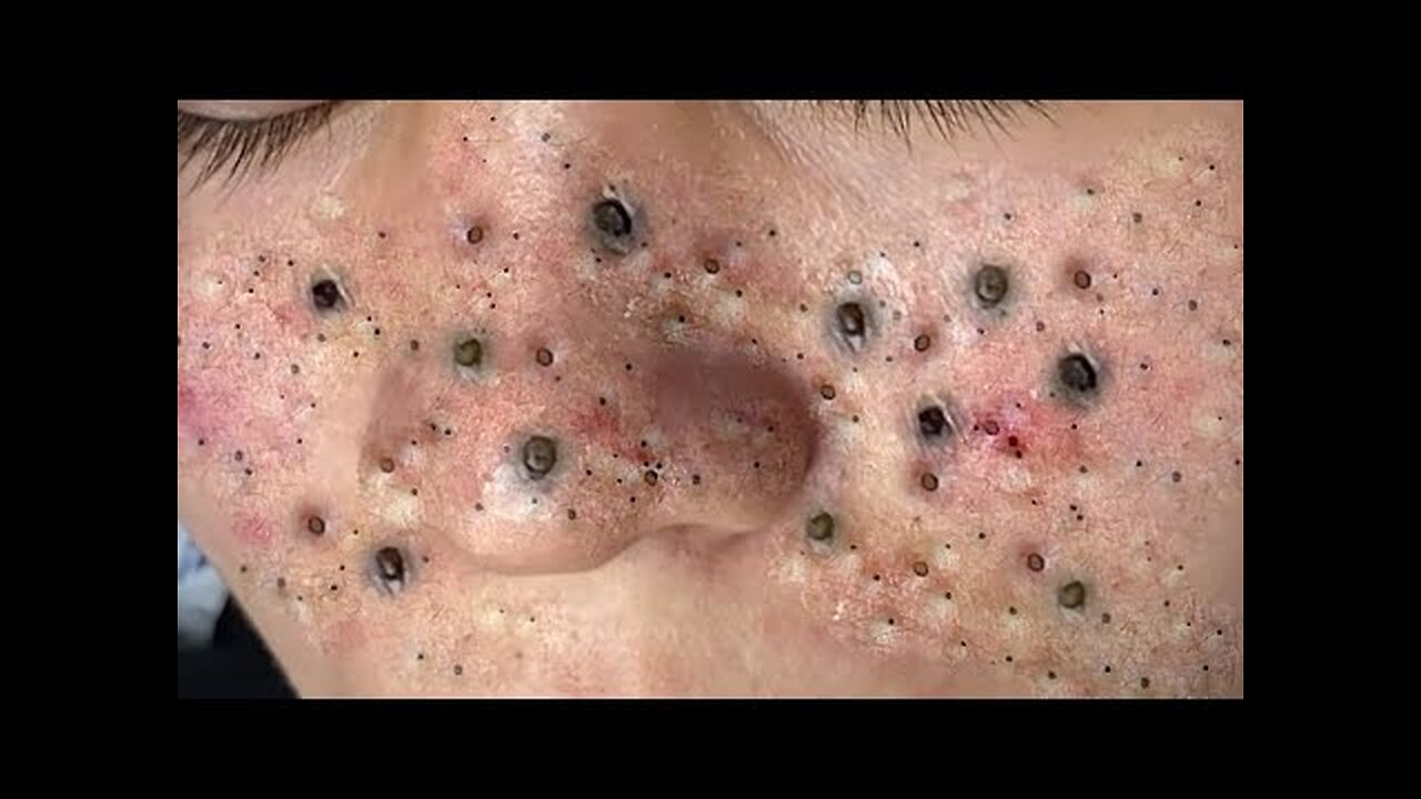 Blackheads removal relaxing, PimplePopper Extraction