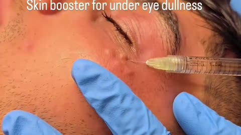 Revitalize Tired Eyes with Under-Eye Skin Boosters