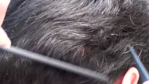 Hair Restoration Scar Repair – Dr. Brett Bolton