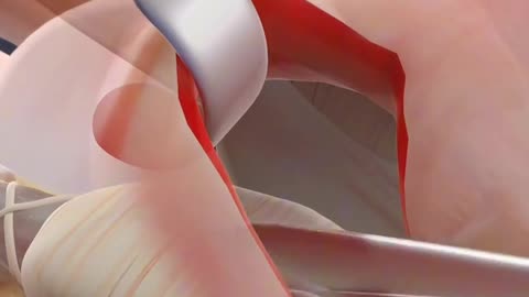 Trigger Finger Release Surgery (3D Animation)