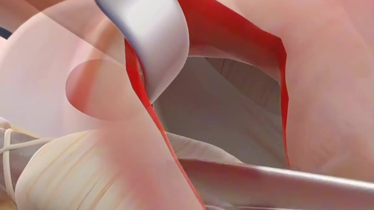 Trigger Finger Release Surgery (3D Animation)