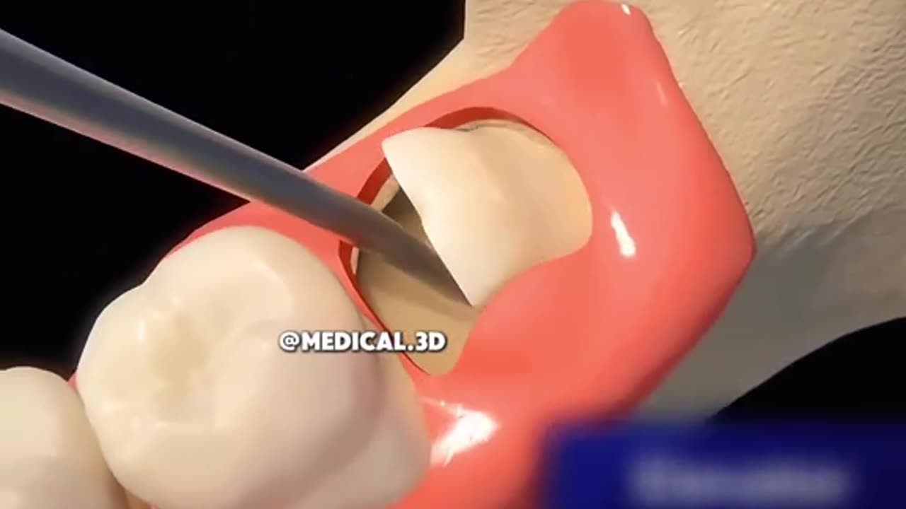 Tooth Extraction Procedure (3D Animation)