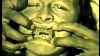 Dr Weston A. Price - Tooth decay