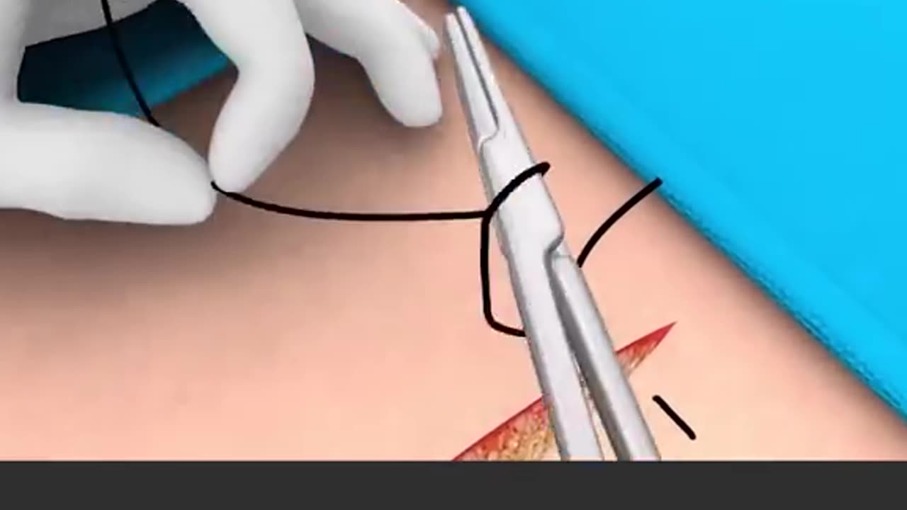 How Surgical Sutures Are Made In Our Skin 3D Animation