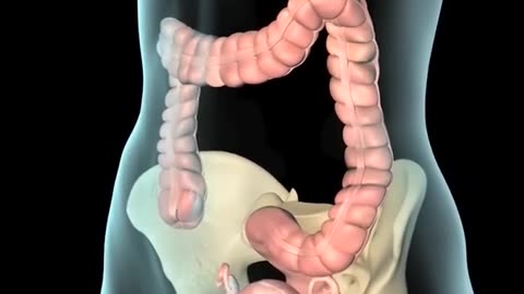 Vaginal Pessary Ring Insertion Procedure 3D Animation