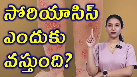 సోరియాసిస్ ఎందుకు వస్తుంది ? What are the Causes for Psoriasis ? Homeopathy Treatment Cure Medicine