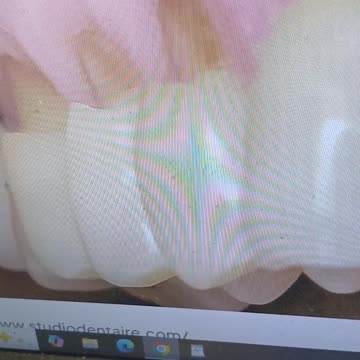 Abfraction: An Unusual Hole in Teeth