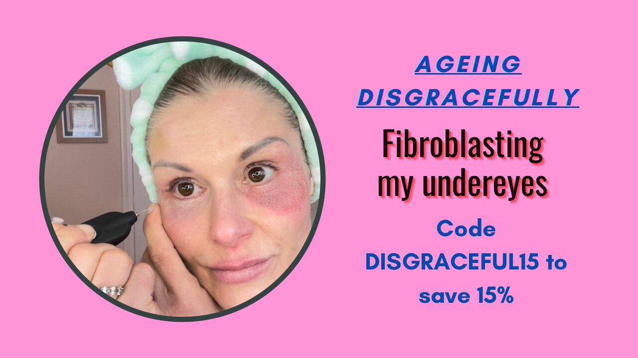 Fibroblast my undereyes