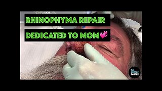 Rhinophyma Repair Dedicated to MOM